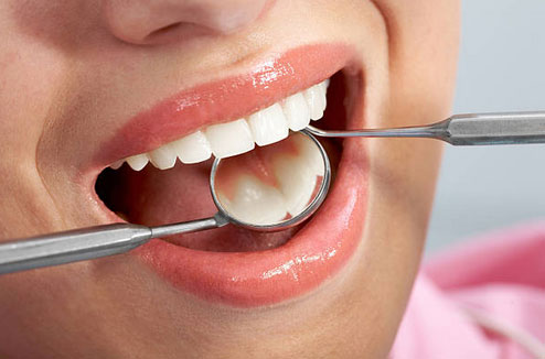 dental fillings in tarpon springs