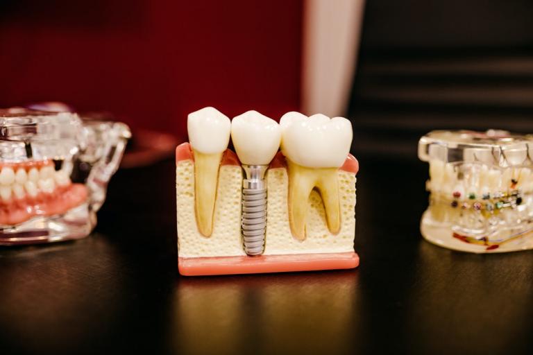 dental implants tarpon springs