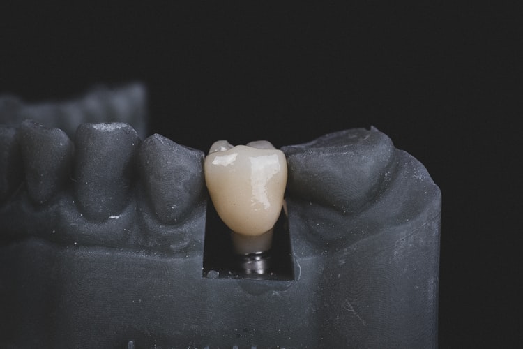 dental implant emergency dentist harbor