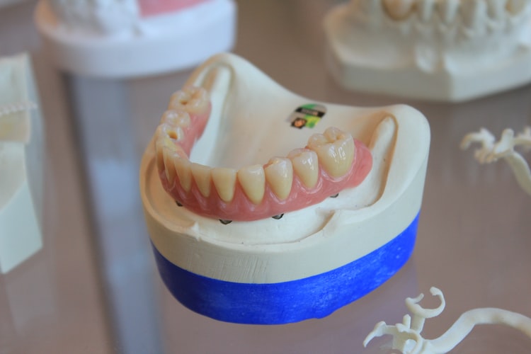dental implants vs dentures tarpon springs