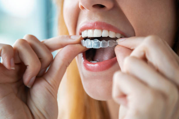 inman aligner treatment tarpon springs fl