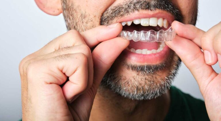 No Adjustments Needed: Living Naturally with Invisalign